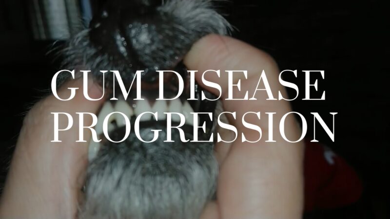 Gum Disease Progression and Black Gums